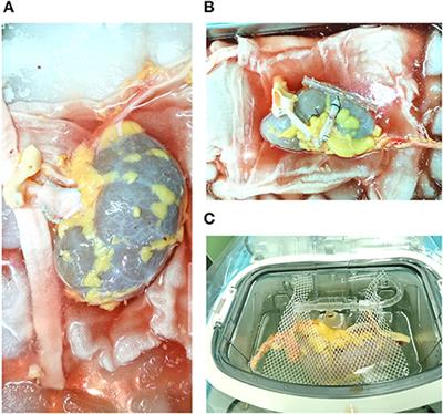 Machine Retrograde Perfusion of Deceased Donor Kidneys: A Prospective Study